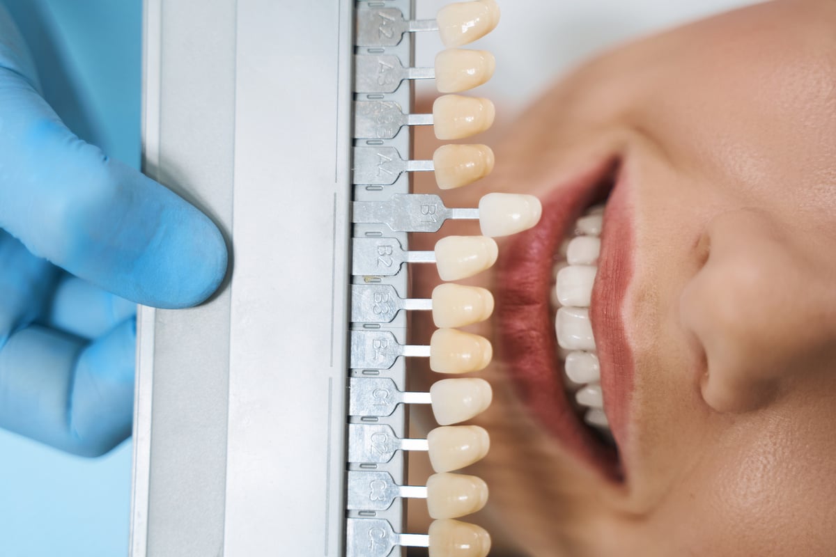 Top view of dentist with veneers palette stock photo